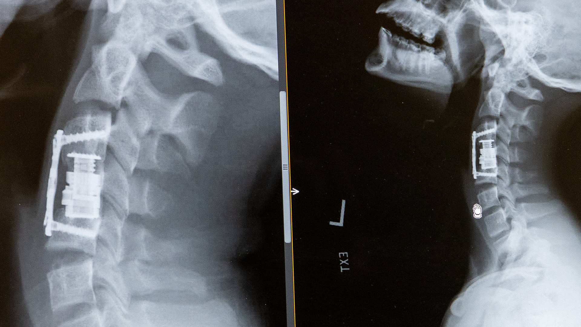 x-ray images that show a titanium metal cylinder in place of a vertebra