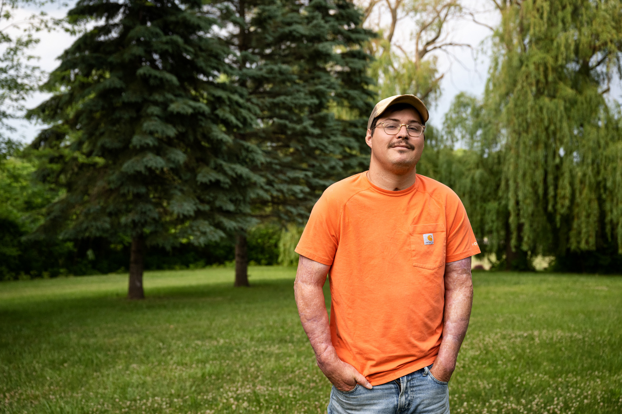 James Rogers, a former patient at the University of Iowa Burn Treatment Center, standing outdoors