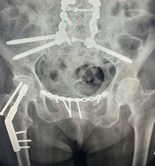 pelvic x-ray