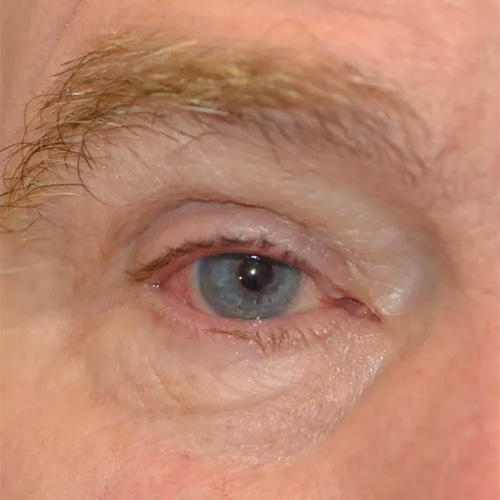 closeup of an eye, after a medical procedure