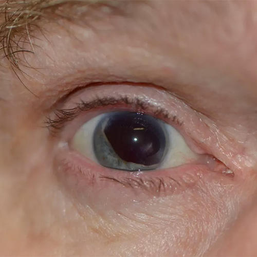 closeup of an eye, before a medical procedure