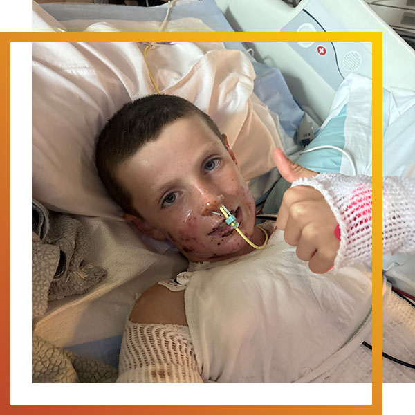 a burn patient gives a thumbs-up while in his hospital bed