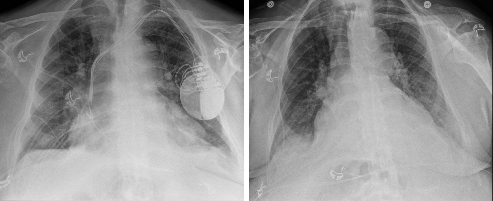 x-ray imges, one showing a cardiac device implanted, the other after the device was removed