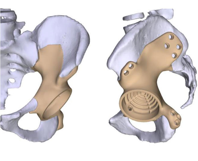 These images show the anticipated fit and appearance of the final prosthesis using 3D planning software from Onkos Surgical