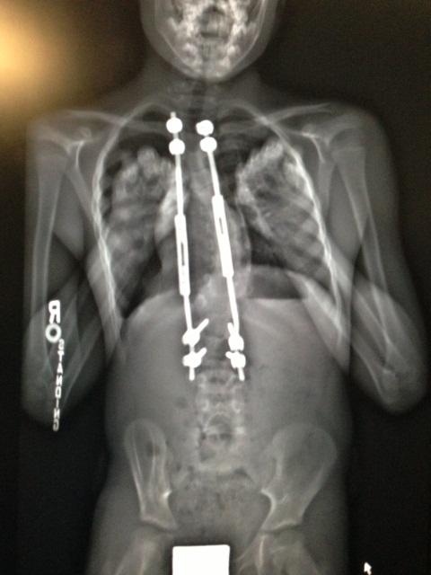 x-ray of the MAGEC rods in Will Imbus