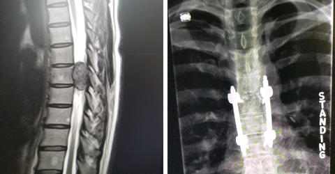 x-rays of Shannon Sampson, first one showing the tumor, second one showing the rods/screws inserted after the tumor was removed