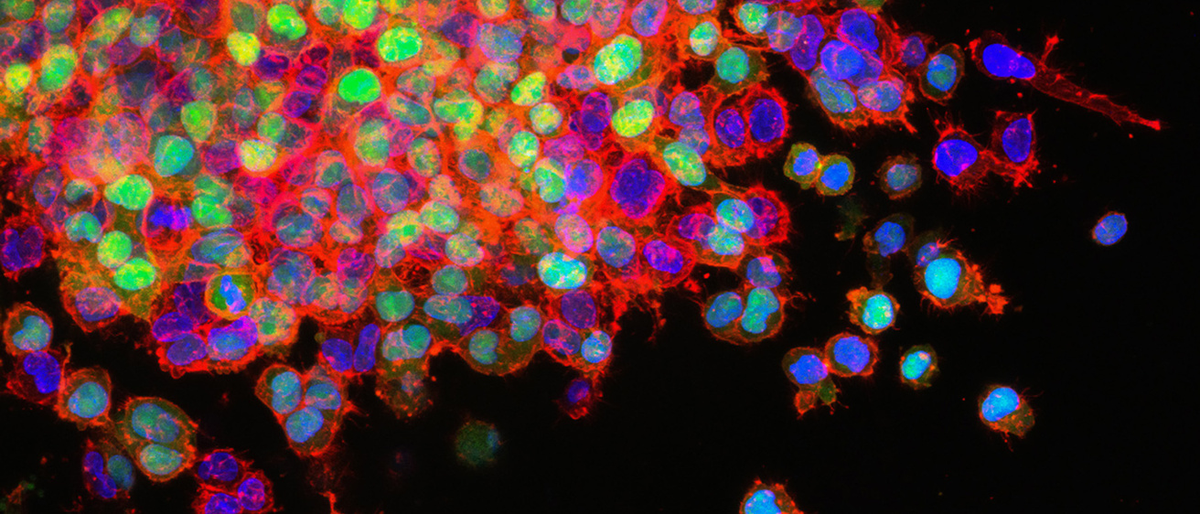 lung cancer mestastis