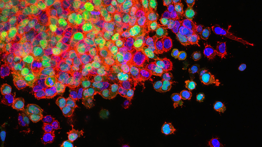 lung cancer mestastis