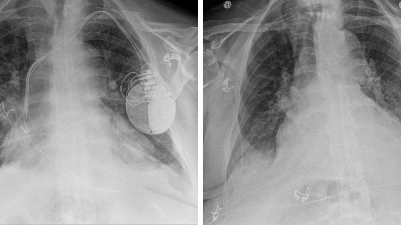 An X-ray image of someone's chest